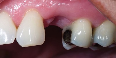 5 hậu quả khôn lường nếu bị mất răng sớm!