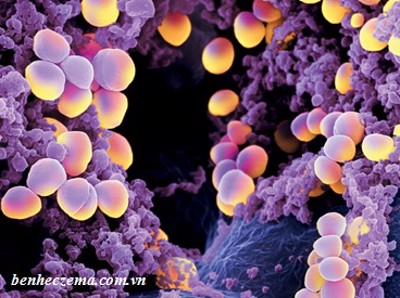 Phát hiện mới về vi khuẩn Staphylococcus aureus và bệnh eczema