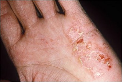 Triệu chứng và cách điều trị bệnh eczema như thế nào?