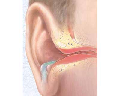 5 biến chứng cực kỳ nguy hiểm của viêm tai giữa