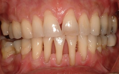 3 điều cần thực hiện ngay để điều trị viêm quanh răng, tụt lợi