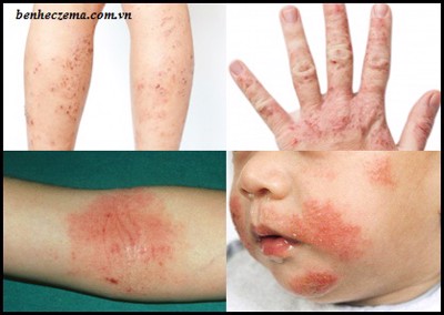 Thông tin tổng quan về bệnh eczema