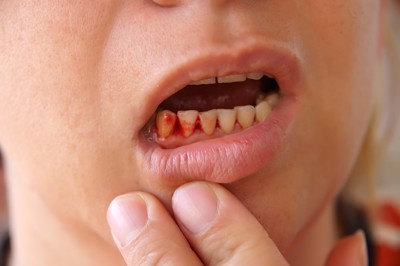 Chảy máu chân răng khi đánh răng: Dấu hiệu chớ coi thường!