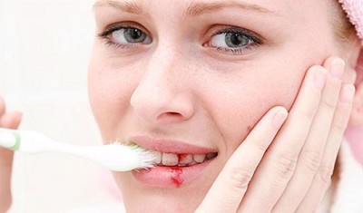 6 cách lý tưởng để không bị chảy máu chân răng khi đánh răng