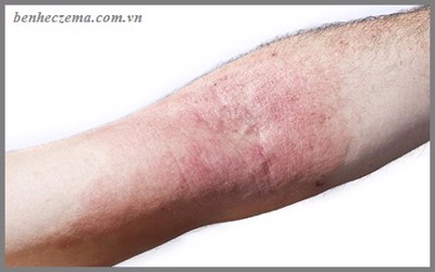 6 lầm tưởng về bệnh eczema nhiều người mắc phải