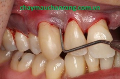 Cơ chế hình thành viêm chân răng có mủ