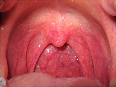 Cảnh báo nguy cơ biến chứng của viêm vòm họng