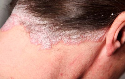 Vẩy nến da đầu và cách điều trị hiệu quả