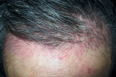 Kiên trì điều trị vẩy nến da đầu