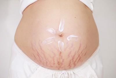 3 lời khuyên hữu ích giúp trị rạn da khi mang thai