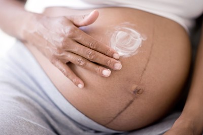 Ngăn ngừa và cải thiện rạn da khi mang thai thế nào là đúng?