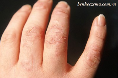 8 câu hỏi thường gặp về bệnh eczema
