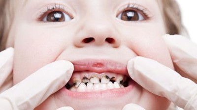 Tiết lộ nguyên nhân gây bệnh sâu răng mà bạn nên biết!