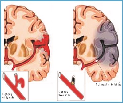 CẬP NHẬT NGAY: Tóm gọn 3 loại đột quỵ não thường xảy ra 