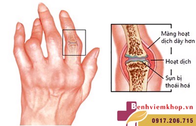 ĐỪNG ĐÙA: Viêm khớp dạng thấp có thể gây ung thư đấy!