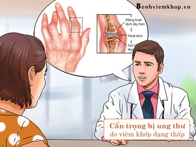 LẠNH GÁY vì UNG THƯ do viêm khớp dạng thấp