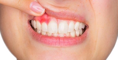 Làm sao để chấm dứt tình trạng hôi miệng và chảy máu chân răng?