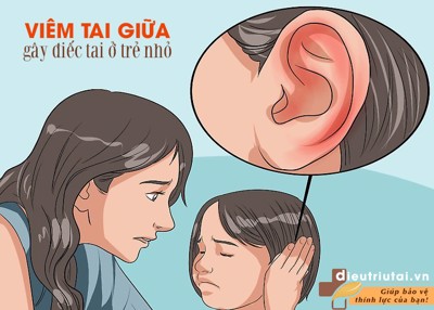 VIÊM TAI GIỮA - Kẻ thù SỐ 1 gây điếc tai ở trẻ