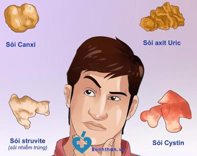 SỰ THẬT về các loại SỎI THẬN khiến người đọc NGÃ NGỬA