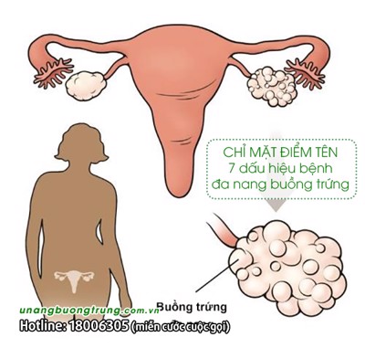 CHỈ MẶT ĐIỂM TÊN 7 dấu hiệu của bệnh đa nang buồng trứng