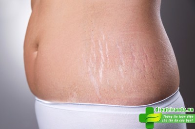 Cách khắc phục những vết rạn da sau sinh hiệu quả nhất là gì?