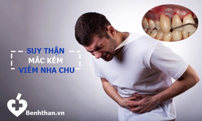 Tại sao nếu mắc SUY THẬN kèm viêm nha chu thì rất nguy hiểm?