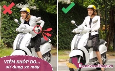 VIÊM KHỚP ngày càng phổ biến ở Việt Nam do sử dụng… xe máy