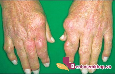 Chân tay sưng phồng, dấu hiệu VIÊM KHỚP DẠNG THẤP đã “ghé thăm”