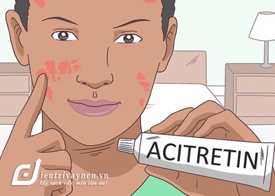 Thuốc trị vẩy nến acitretin tốt hay không? Click đọc ngay! 