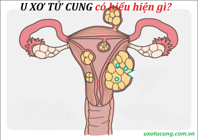 Bệnh u xơ tử cung có biểu hiện gì? – ĐỌC NGAY để biết thêm chi tiết!