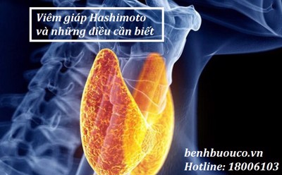 Viêm giáp Hashimoto và những điều cần biết