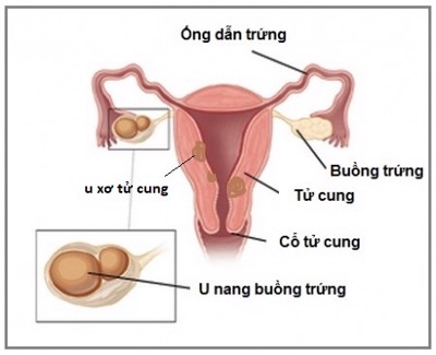 U xơ tử cung là gì và u nang buồng trứng là gì?