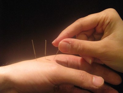 Có nên điều trị viêm khớp dạng thấp bằng cách châm cứu không? - Chuyên gia Vũ Tuấn Anh tư vấn