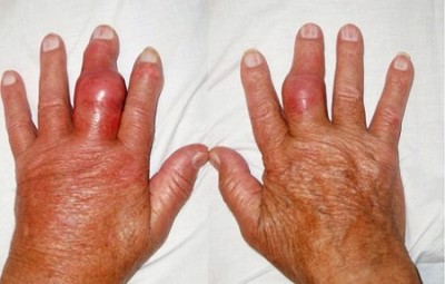 Cách phòng bệnh viêm khớp dạng thấp hiệu quả nhất là gì? - Chuyên gia Nguyễn Đình Cường tư vấn