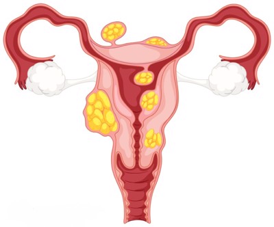 U xơ tử cung là gì và u nang buồng trứng là gì? GS.TS.Nguyễn Đức Vy giải đáp