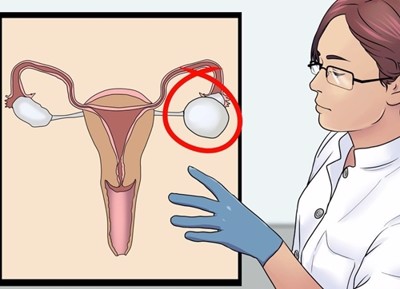 Cách phòng ngừa u nang buồng trứng, u xơ tử cung là gì? Chuyên gia Nguyễn Đức Vy phân tích