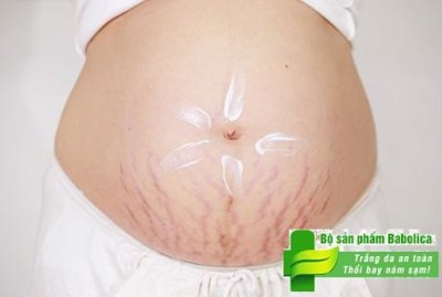 Phòng ngừa rạn da bụng khi mang thai như thế nào?