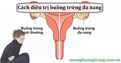 Cách điều trị buồng trứng đa nang hiện nay là gì?