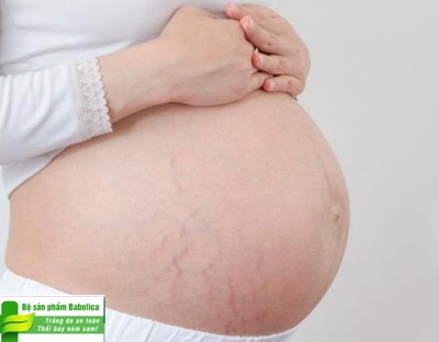 Bị rạn da khi mang thai? Bật mí cách trị RẠN DA Ở BÀ BẦU an toàn