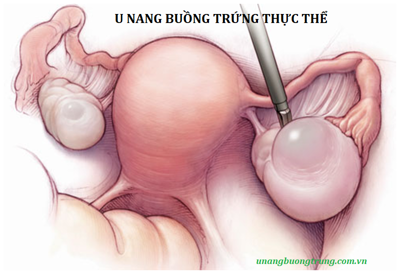 U nang buồng trứng thực thể và cách điều trị