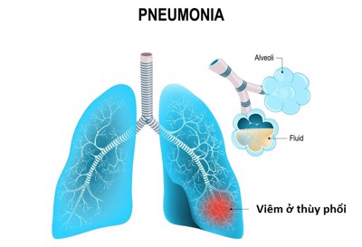 Bệnh viêm phổi thùy và những điều bạn không nên bỏ qua
