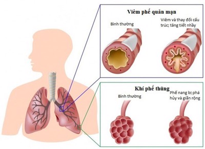 Viêm phổi và viêm phế quản - Cách nhận biết và điều trị như thế nào? Chuyên gia giải đáp