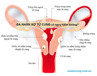 Bệnh đa nhân xơ tử cung có nguy hiểm không? Đây là câu trả lời!