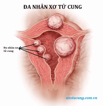 Đa nhân xơ tử cung và những điều bạn chưa biết