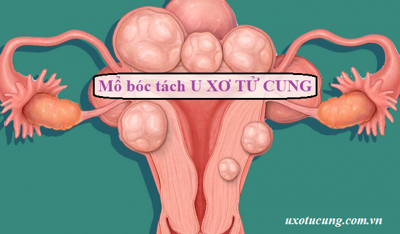 Mổ bóc tách u xơ tử cung có tốt không? - Câu trả lời hay cho bạn!