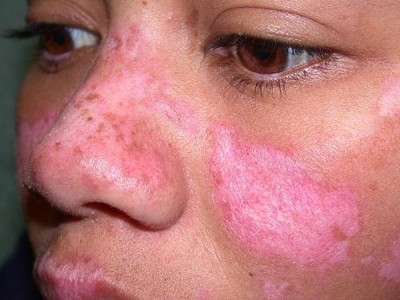 Bệnh lupus ban đỏ biến chứng thận thì phải làm sao? Chuyên gia Nguyễn Thành trả lời