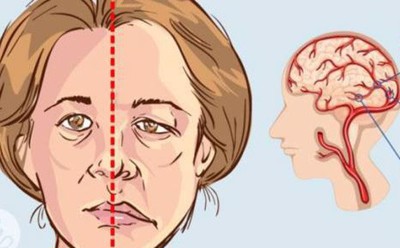 Thời gian vàng để xử trí tai biến mạch máu não là như thế nào? 