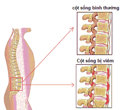 Các phương pháp điều trị đau lưng mãn tính không cần phẫu thuật