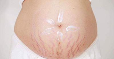 Dấu hiệu rạn da khi mang bầu là bị ngứa phải không? Cách phòng ngừa như thế nào?