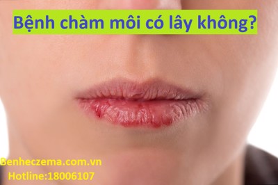 Bệnh chàm môi có lây không? Click xem ngay tại benheczema.com.vn